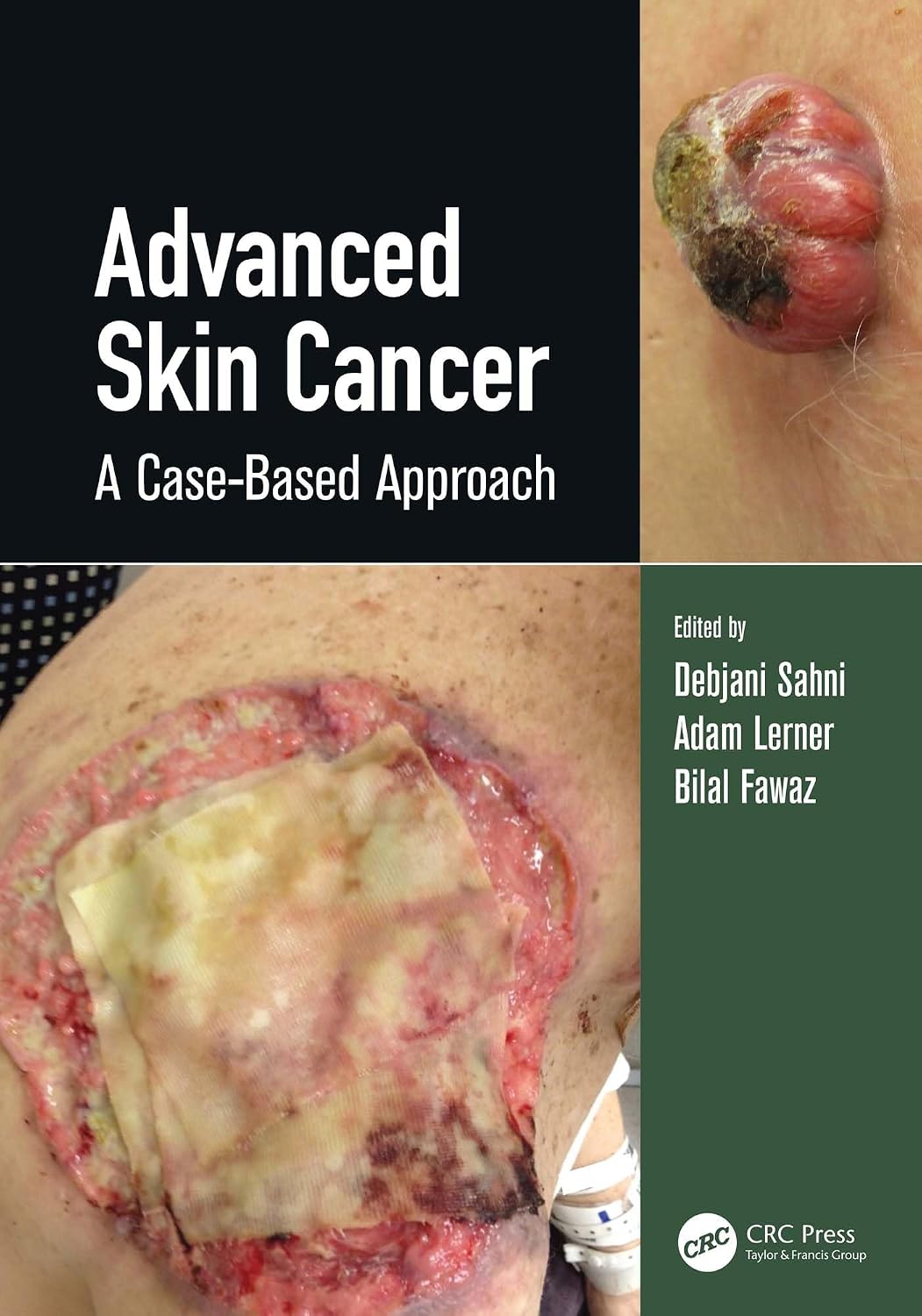 Advanced Skin Cancer cover