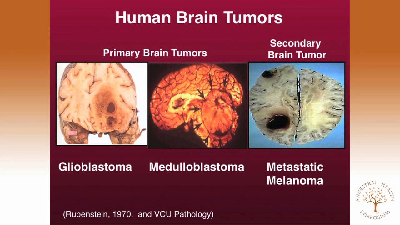 Thomas Seyfried, PhD — Targeting Energy Metabolism in Brain Cancer thumbnail